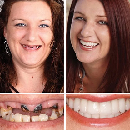'--Ends Today: 75% OFF! ⏰DarkFairy™ Medical Full Denture with Strong Suctiond Custom-Fit Full Functional Dentures🦷